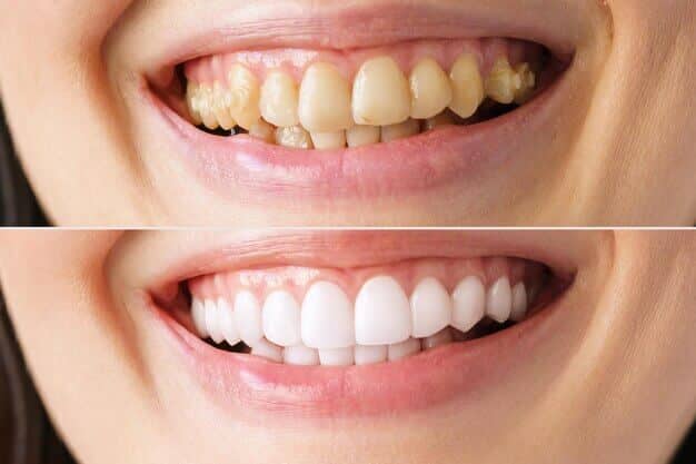 Clareamento dental