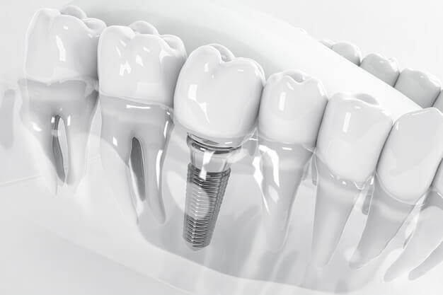 Implantes dentario